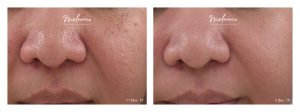 Picosure Freckles, Pores, & Uneven Skin Tone